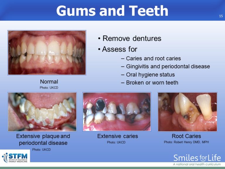 Module 8 Slide 15 | Smiles for Life Oral Health